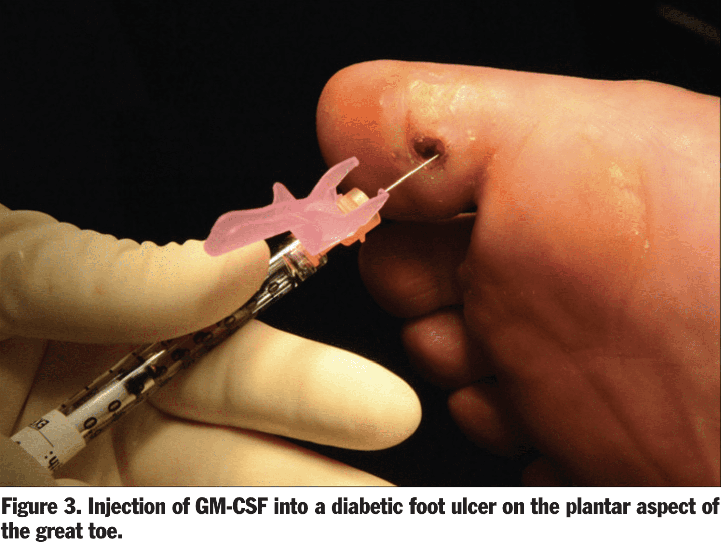 Brem H, Howell R, Criscitelli T, Senderowicz A, Siegart N, Gorenstein S, Gillette B. Practical Application of Granulocyte-Macrophage Colony-Stimulating Factor (GM-CSF) in Patients with Wounds. Surg Technol Int. 2018 Jun 1;32:61-66. PMID: 29611156.