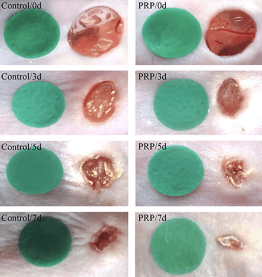 Sequential photographs of skin wounds in mice treated with saline and PRP at different time points (days 3, 5 and 7 after injection). 

Xu P, Wu Y, Zhou L, Yang Z, Zhang X, Hu X, Yang J, Wang M, Wang B, Luo G, He W, Cheng B. Platelet-rich plasma accelerates skin wound healing by promoting re-epithelialization. Burns Trauma. 2020 Aug 14;8:tkaa028. doi: 10.1093/burnst/tkaa028. PMID: 32821743; PMCID: PMC7427034.