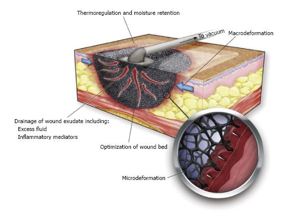 The 4 primary mechanisms of microdeformational wound therapy: (1) macrodeformation; (2) microdeformation (3) fluid removal; and (4) alteration of the wound environment

Panayi AC, Leavitt T, Orgill DP. Evidence based review of negative pressure wound therapy. World J Dermatol 2017; 6(1): 1-16 [DOI: 10.5314/wjd.v6.i1.1]

1. Panayi A, Leavitt T, Orgill D. Evidence based review of negative pressure wound therapy. World Journal of Dermatology. 2017 Jan;6:1–16. 
